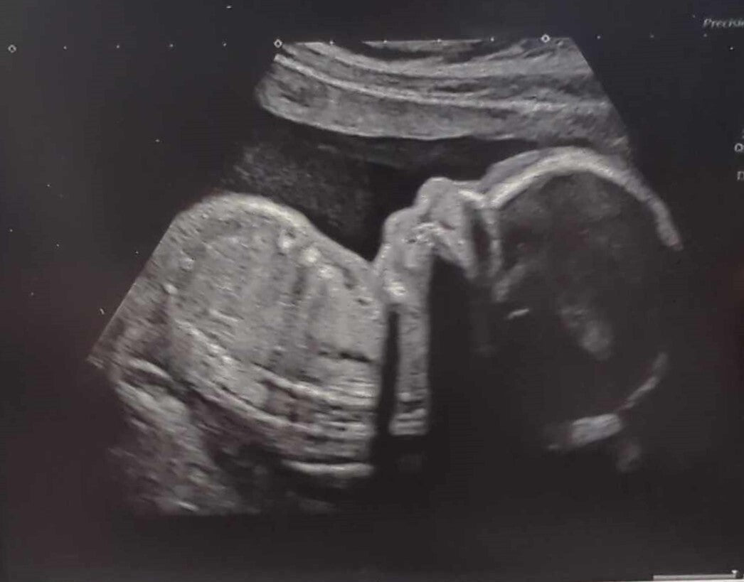 Personalized Ultrasound Image Keychain and Wallet Card